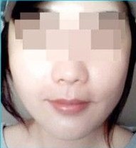 三周，接受术后管理后