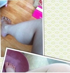 手术后天，医生说要得等消肿，而加所拍的都是肿着!要穿定形裤4个月。
图片像PS过吧?才没有PS～哈哈，我好开心! (上是手术前，下是手术后刚穿上紧身裤拍下)