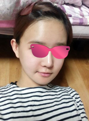 现在离手术已经有大半年了，自己没有感到什么的不适。自己保养的挺好，愿自己永远童颜，快乐的过下去。虽然这是不可能的啦，嘿嘿