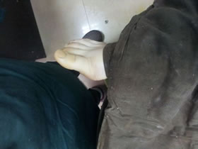 手术后，右脚，侧面，几乎看不到手术切口，对不对?