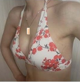 假体丰胸术后穿比基尼