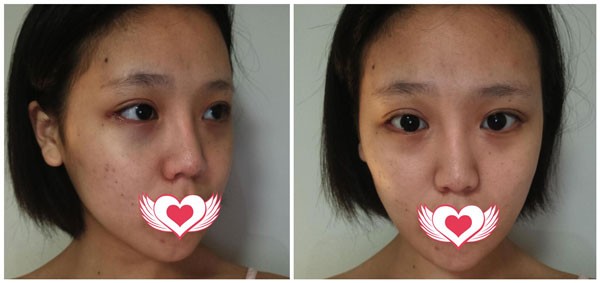 我在宁波童颜做全脸脂肪填充6天脸好涨,15天后自然了好多