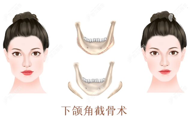 上海做下颌角截骨手术比较好的医院名单
