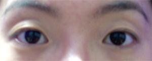 双眼皮手术前照片
