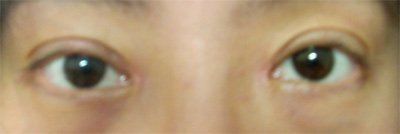 手术后十几天的照片