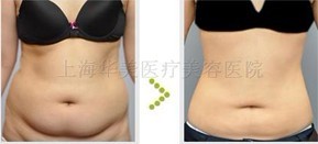 上海华美整形—腰腹吸脂对比案例