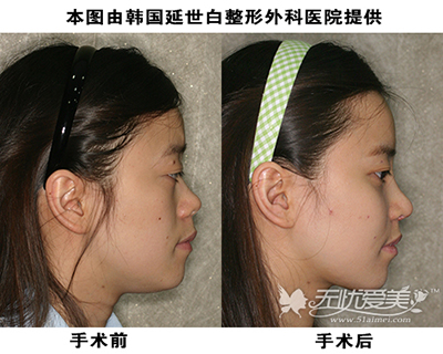 韩式隆鼻手术案例对比照片