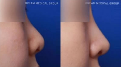 鼻头鼻尖整形手术前后对比案例图