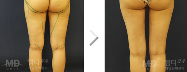 大腿内侧及臀部吸脂手术前后对比照片