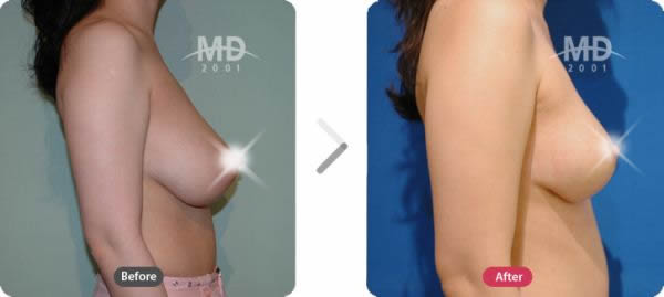 韩国MD整形外科乳房下垂矫正术+假体隆胸对比案例