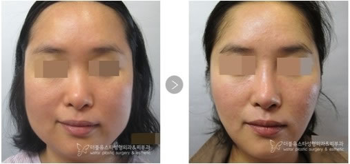 韩国W-star整形外科医院颜面轮廓手术对比案例