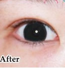 韩式双眼皮整形术前后对比照片