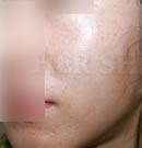 注射PRP改善皮肤斑痕案例对比