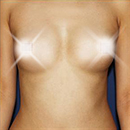 隆胸手术案例对比图