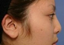 注射自体脂肪隆鼻前后对比图