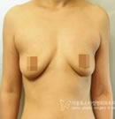 韩国W-star整形外科医院胸部整形手术对比案例