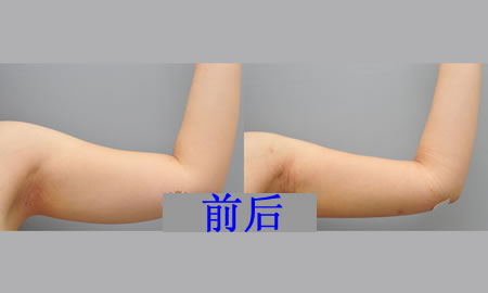 我选择南京康美整形医院是没有错的，不仅手术效果好，而且手术恢复过程不痛苦，跟随我多年的胖手臂终于瘦下来了。