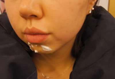 想做个下巴的MM们， 注射也不错哈~