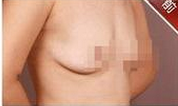 乳房下垂矫正+假体丰胸术前