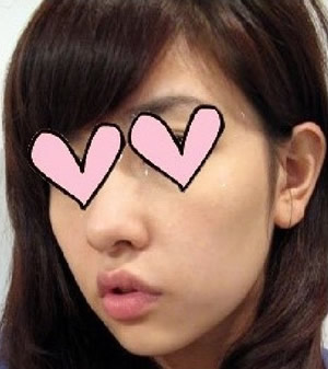 周围的人都劝我不要做手术，说这样也挺好的，但是他们都没有站在我的立场上为了我考虑一下~~~每次去相亲会，都会因为下巴而宣告失败，再者夏天的时候因为方下巴，都没有将头发扎起来一次……每个夏天都得忍受闷热。