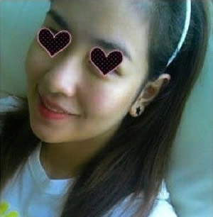 手术之后真的成了完全的V-line!!这是手术后不到一个月时拍的照片!这个时候是浮肿还没有全部消掉的状态~但是我还是不顾形象的将头发别在耳后，现在脸稍长了些吧??
