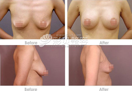 乳房下垂怎么办 乳房下垂矫正重拾性感