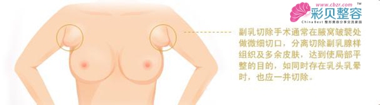 副乳切除自有妙招 让胸部不再烦恼