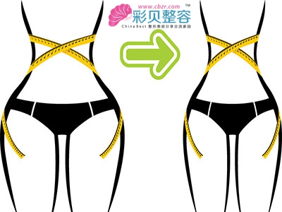 吸脂术