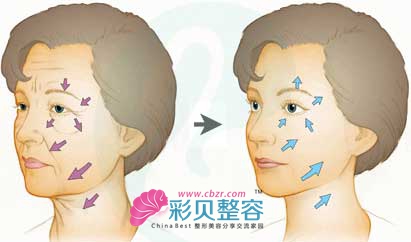 内窥镜除皱 冻龄实现不是梦