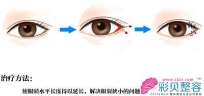 开内眼角