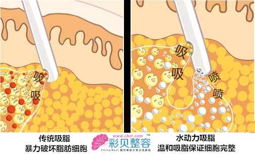 吸脂方法对比