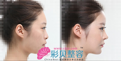 硅胶隆鼻前后对比