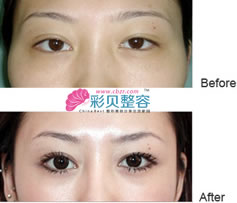 开内眼角案例对比图