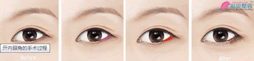 开外眼角手术过程图
