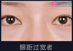 开眼角手术适用人群