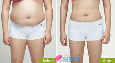 腰腹吸脂前后对比