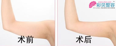 手臂吸脂前后对比
