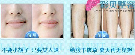 冰点脱毛前后对比