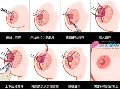 乳头内陷手术矫正过程