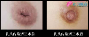 乳头内陷矫正前后对比