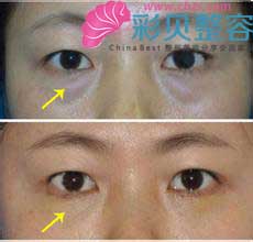 吸脂祛眼袋效果