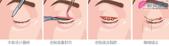 眼综合整形手术过程图