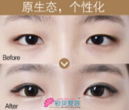 眼综合整形手术优势
