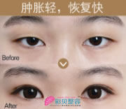眼综合整形手术优势
