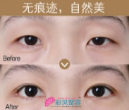 眼综合整形手术优势