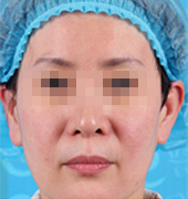 面部抗衰手术案例