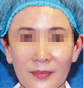 面部抗衰手术案例
