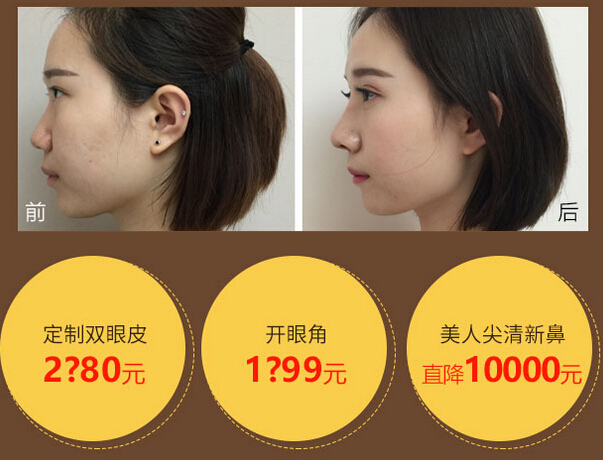 双眼皮开眼角隆鼻整形价格优惠图