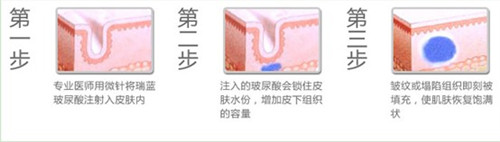 玻尿酸除皱原理