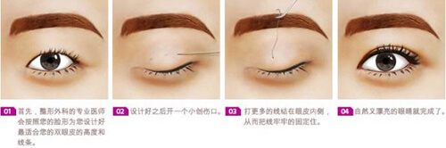 埋线双眼皮手术过程
